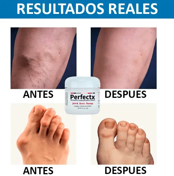 Perfectx™ Terapia Articular Y Muscular CurePro